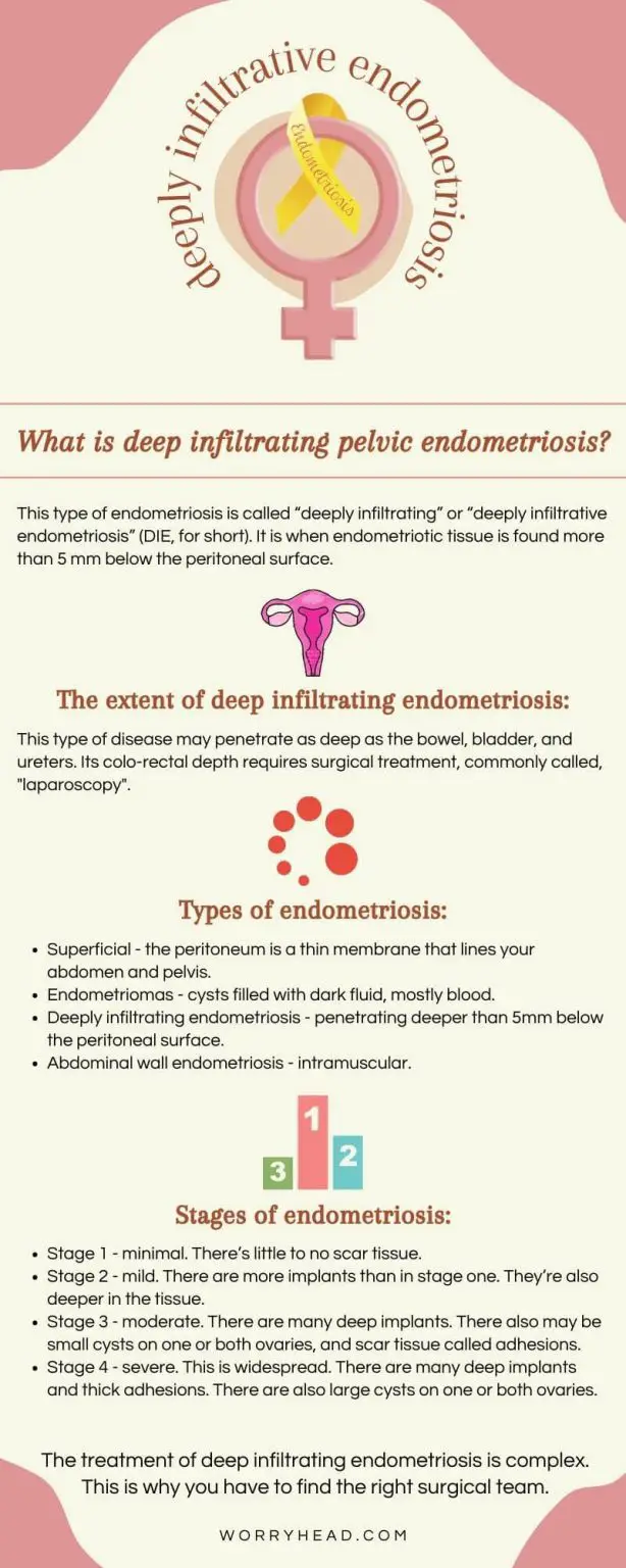 What Is Deep Infiltrating Pelvic Endometriosis. Endometriosis.