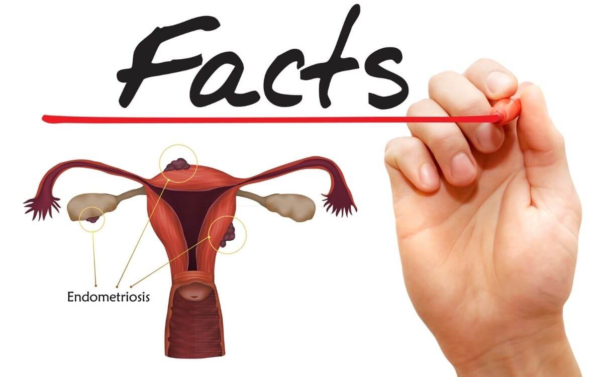 facts men should know about endometriosis