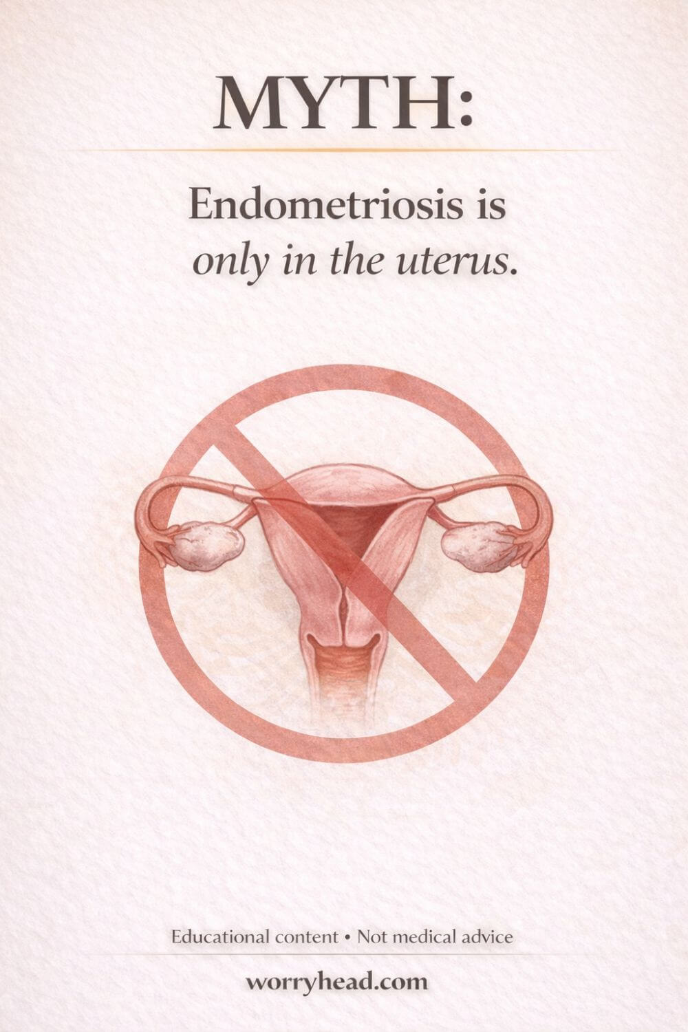 Endometriosis Myths and Facts 2